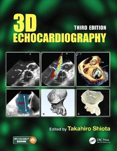 3D echocardiography
