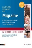Illustrated treatment for migraine using acupuncture, moxibustion and tuina massage