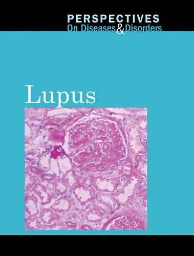 Lupus